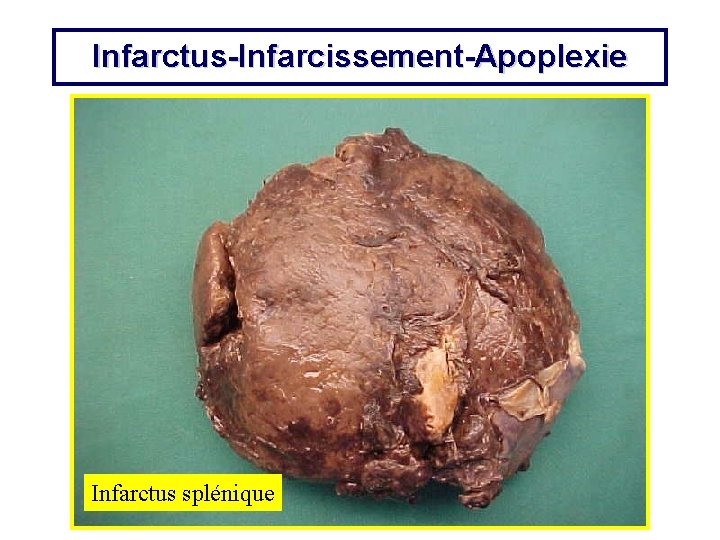 Infarctus-Infarcissement-Apoplexie Infarctus splénique 