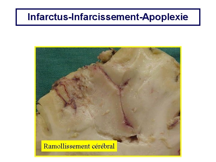 Infarctus-Infarcissement-Apoplexie Ramollissement cérébral 