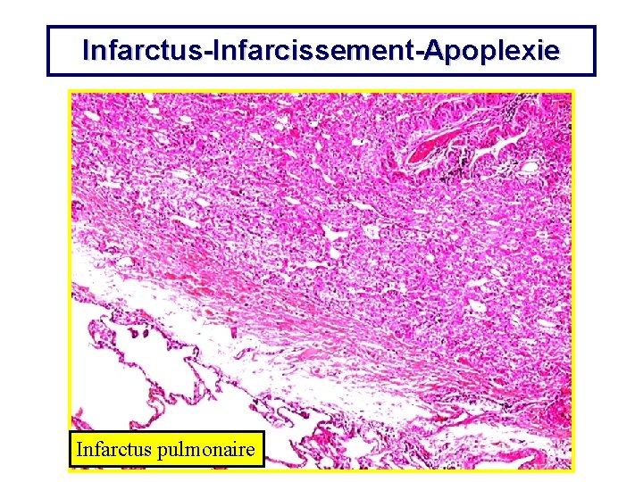 Infarctus-Infarcissement-Apoplexie Infarctus pulmonaire 