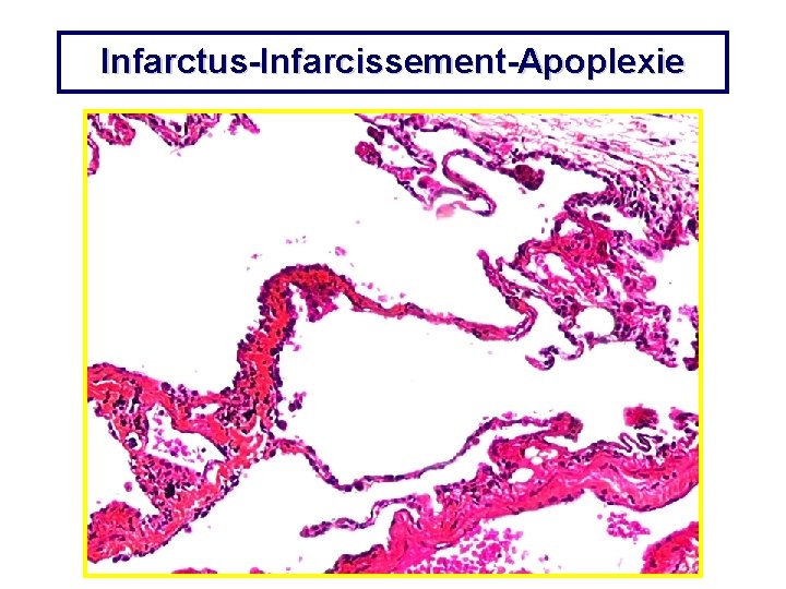 Infarctus-Infarcissement-Apoplexie 