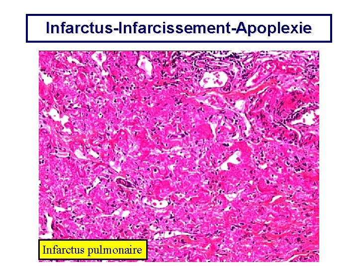 Infarctus-Infarcissement-Apoplexie Infarctus pulmonaire 