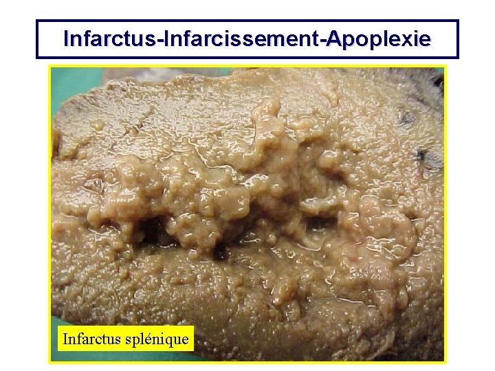 Infarctus-Infarcissement-Apoplexie Infarctus splénique 