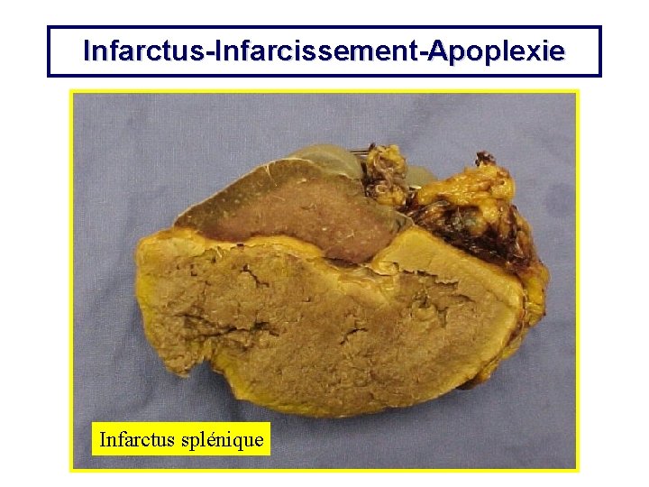 Infarctus-Infarcissement-Apoplexie Infarctus splénique 