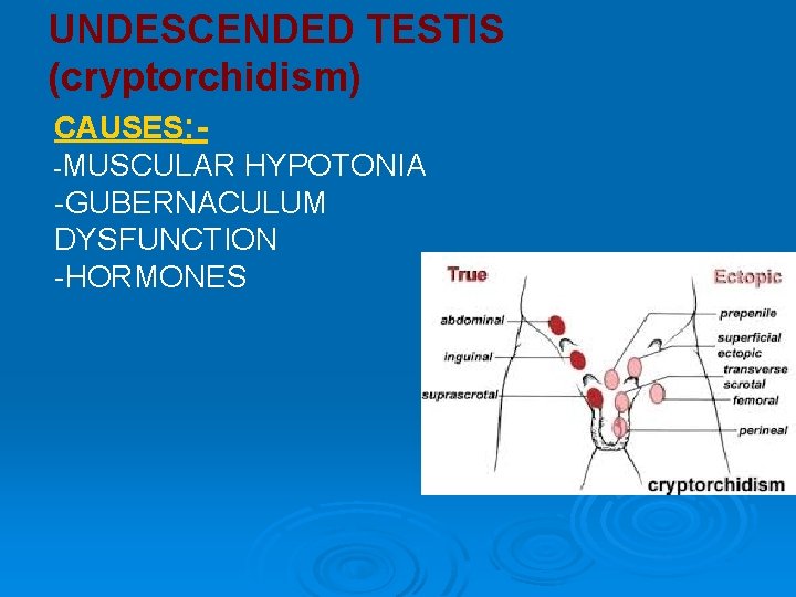 UNDESCENDED TESTIS (cryptorchidism) CAUSES: -MUSCULAR HYPOTONIA -GUBERNACULUM DYSFUNCTION -HORMONES UNDESCENDED TESTIS (cryptorchidism) CAUSES: -MUSCULAR HYPOTONIA -GUBERNACULUM DYSFUNCTION -HORMONES