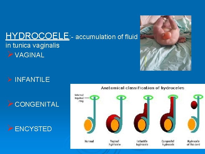 HYDROCOELE: - accumulation of fluid in tunica vaginalis Ø VAGINAL Ø INFANTILE Ø CONGENITAL HYDROCOELE: - accumulation of fluid in tunica vaginalis Ø VAGINAL Ø INFANTILE Ø CONGENITAL