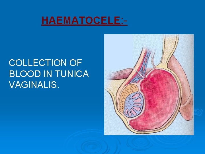 HAEMATOCELE: - COLLECTION OF BLOOD IN TUNICA VAGINALIS. HAEMATOCELE: - COLLECTION OF BLOOD IN TUNICA VAGINALIS.