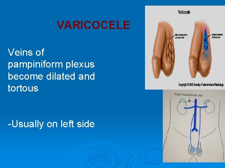 VARICOCELE Veins of pampiniform plexus become dilated and tortous -Usually on left side VARICOCELE Veins of pampiniform plexus become dilated and tortous -Usually on left side
