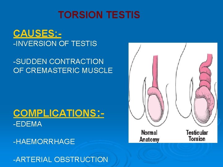 TORSION TESTIS CAUSES: -INVERSION OF TESTIS -SUDDEN CONTRACTION OF CREMASTERIC MUSCLE COMPLICATIONS: -EDEMA -HAEMORRHAGE TORSION TESTIS CAUSES: -INVERSION OF TESTIS -SUDDEN CONTRACTION OF CREMASTERIC MUSCLE COMPLICATIONS: -EDEMA -HAEMORRHAGE