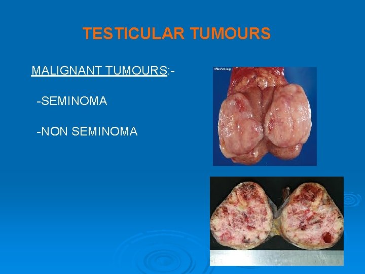 TESTICULAR TUMOURS MALIGNANT TUMOURS: -SEMINOMA -NON SEMINOMA TESTICULAR TUMOURS MALIGNANT TUMOURS: -SEMINOMA -NON SEMINOMA