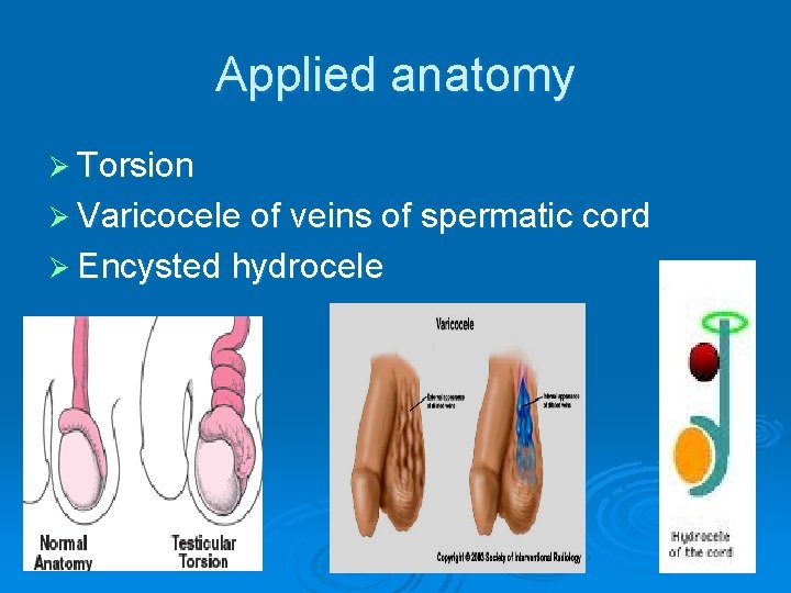 Applied anatomy Ø Torsion Ø Varicocele of veins of spermatic cord Ø Encysted hydrocele Applied anatomy Ø Torsion Ø Varicocele of veins of spermatic cord Ø Encysted hydrocele