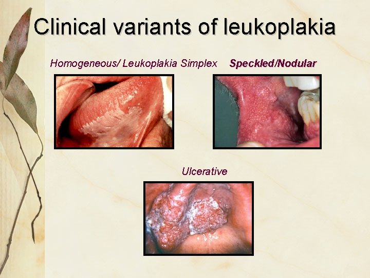 Clinical variants of leukoplakia Homogeneous/ Leukoplakia Simplex Ulcerative Speckled/Nodular 