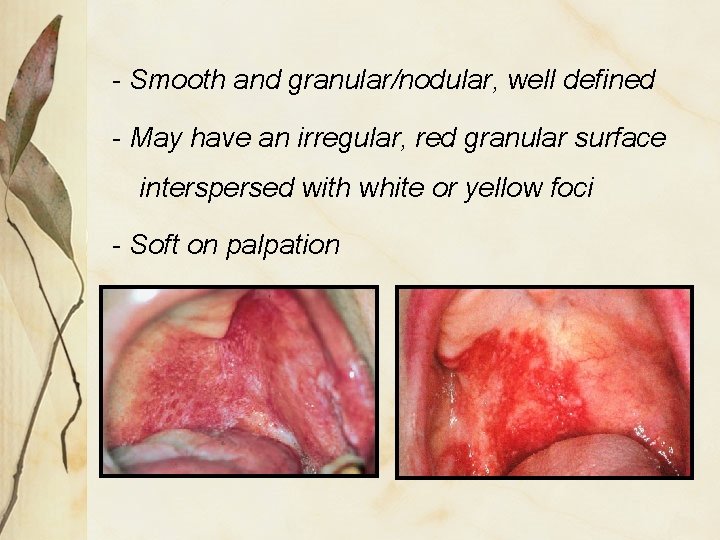 - Smooth and granular/nodular, well defined - May have an irregular, red granular surface