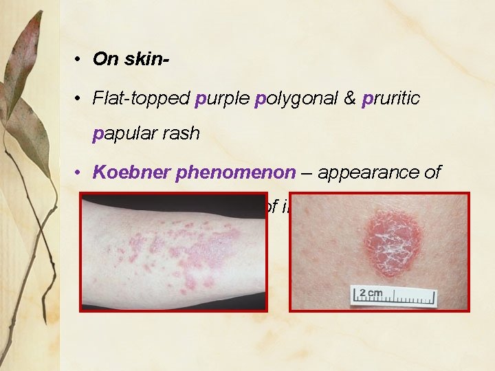  • On skin- • Flat-topped purple polygonal & pruritic papular rash • Koebner