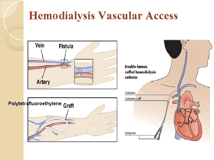 Hemodialysis Vascular Access Polytetrafluoroethylene 
