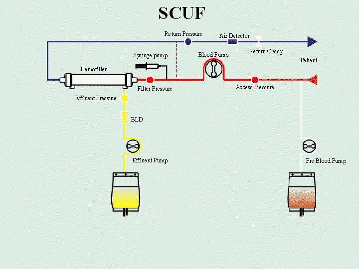 SCUF Return Pressure Syringe pump Air Detector Blood Pump Return Clamp Patient Hemofilter Filter