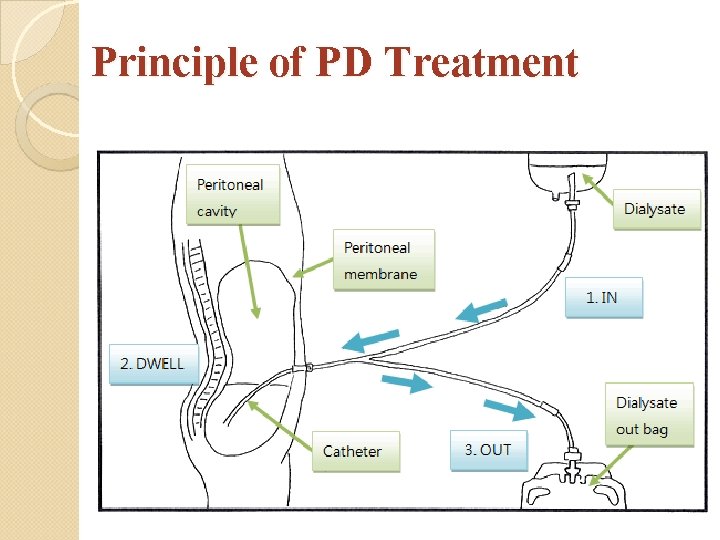 Principle of PD Treatment 