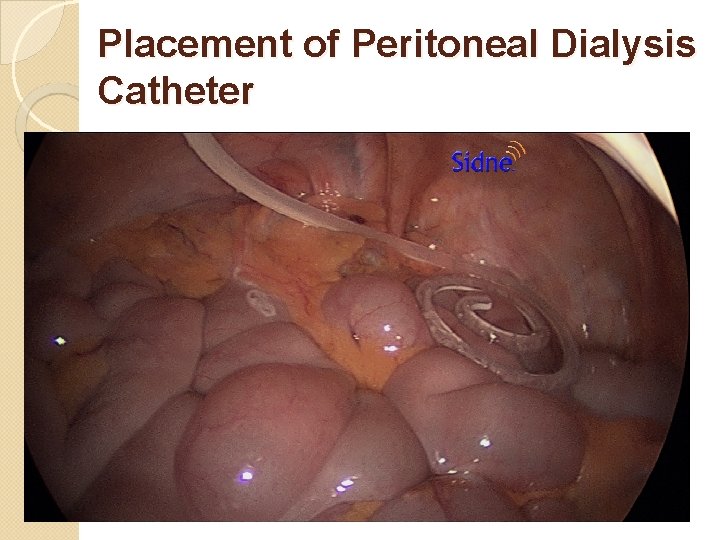 Placement of Peritoneal Dialysis Catheter 