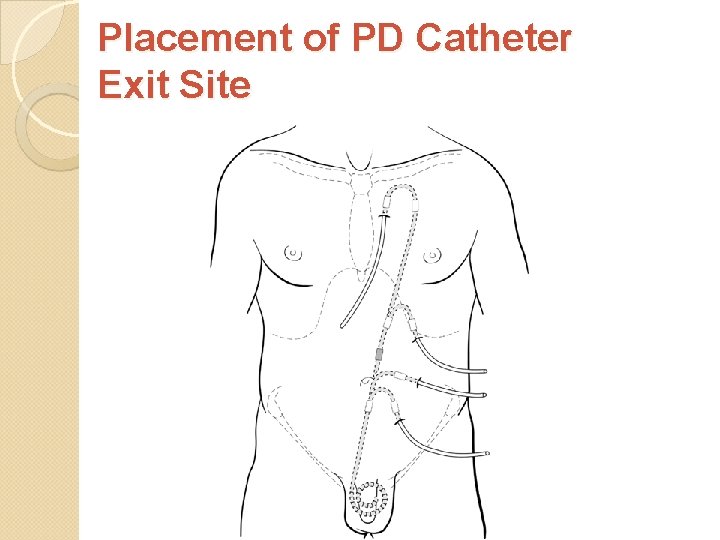 Placement of PD Catheter Exit Site 