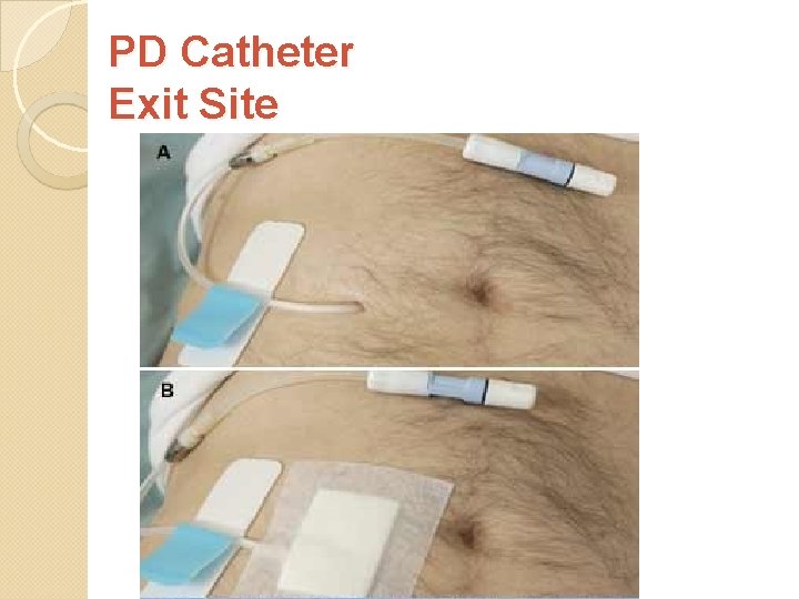 PD Catheter Exit Site 