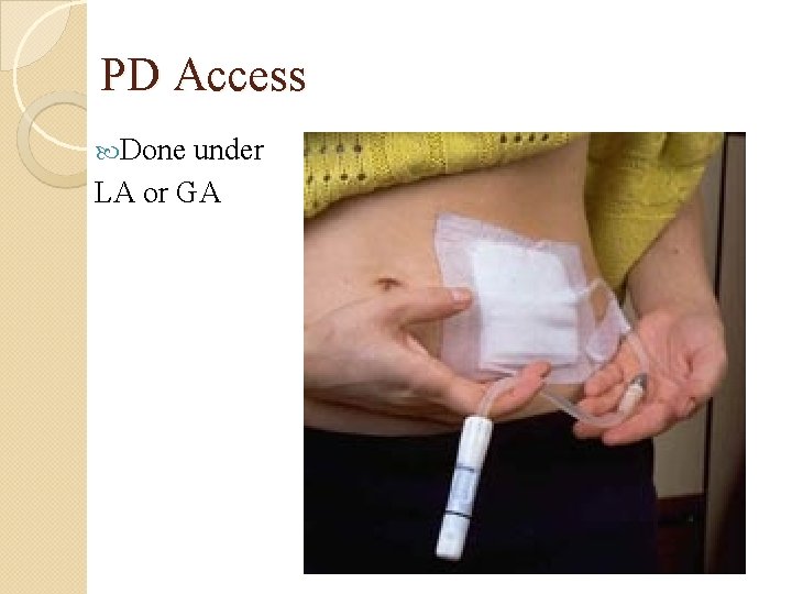 PD Access Done under LA or GA 