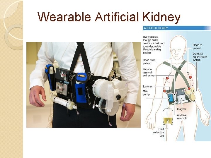 Wearable Artificial Kidney 