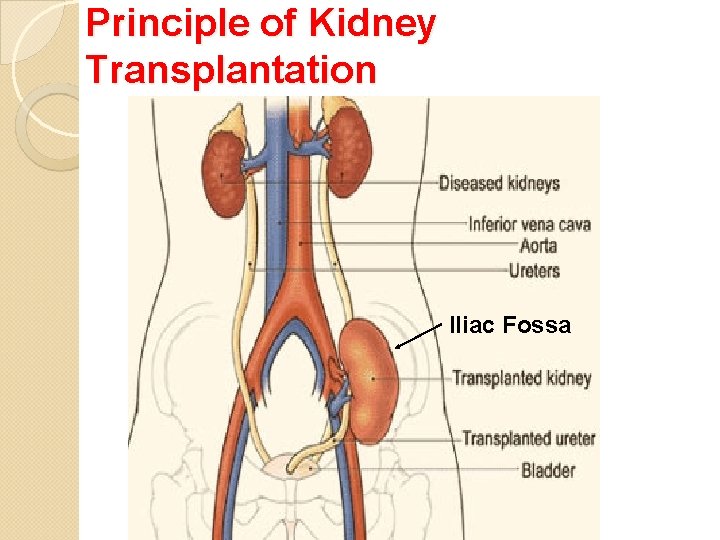 Principle of Kidney Transplantation Iliac Fossa 