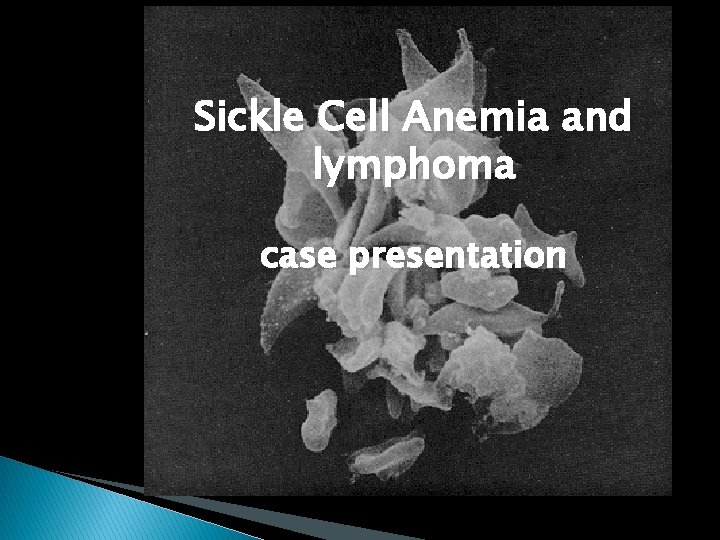 Sickle Cell Anemia and lymphoma case presentation Sickle Cell Anemia and lymphoma case presentation