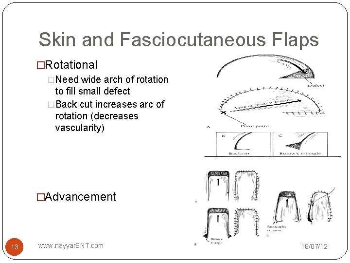 Skin and Fasciocutaneous Flaps �Rotational �Need wide arch of rotation to fill small defect