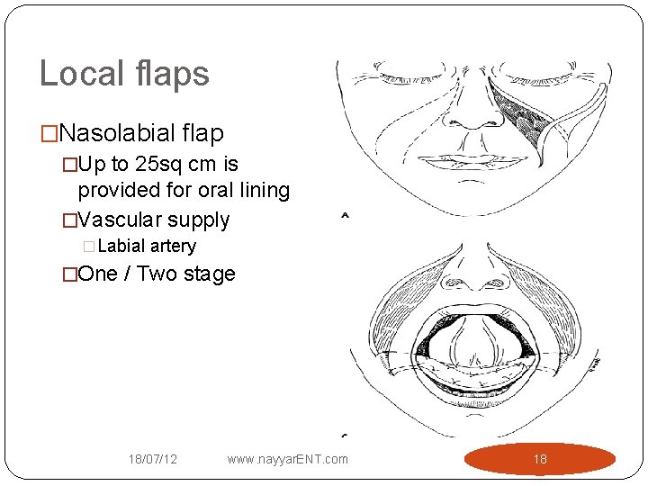 Local flaps �Nasolabial flap �Up to 25 sq cm is provided for oral lining