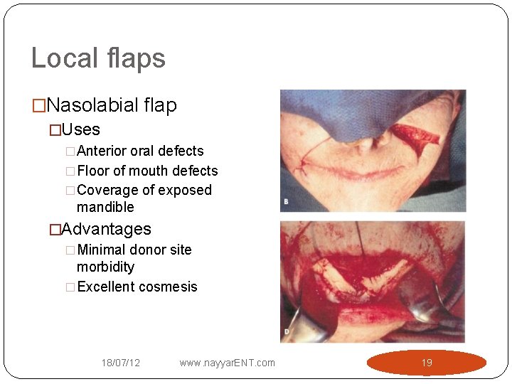 Local flaps �Nasolabial flap �Uses �Anterior oral defects �Floor of mouth defects �Coverage of