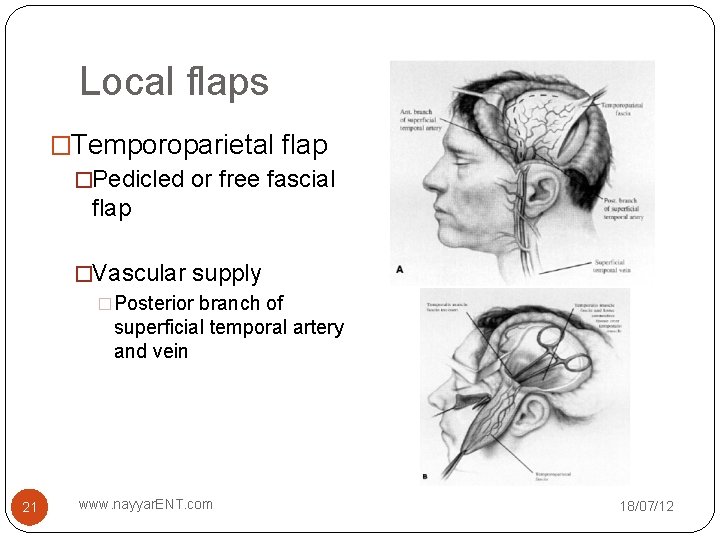 Local flaps �Temporoparietal flap �Pedicled or free fascial flap �Vascular supply �Posterior branch of