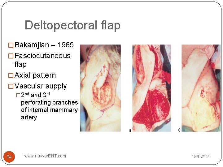 Deltopectoral flap � Bakamjian – 1965 � Fasciocutaneous flap � Axial pattern � Vascular