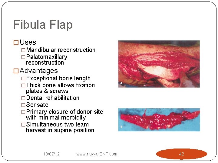 Fibula Flap � Uses �Mandibular reconstruction �Palatomaxillary reconstruction � Advantages �Exceptional bone length �Thick