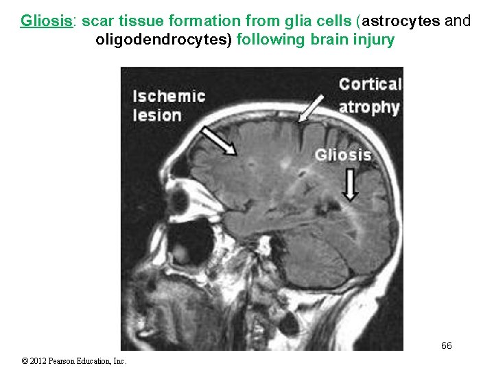Gliosis: scar tissue formation from glia cells (astrocytes and oligodendrocytes) following brain injury 66 Gliosis: scar tissue formation from glia cells (astrocytes and oligodendrocytes) following brain injury 66