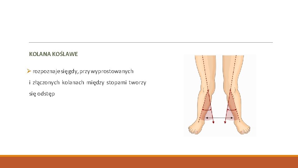 KOLANA KOŚLAWE Ø rozpoznaje się gdy, przy wyprostowanych i złączonych kolanach między stopami tworzy