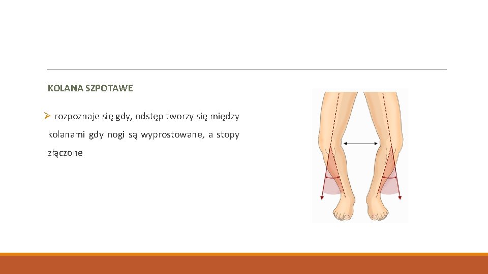 KOLANA SZPOTAWE Ø rozpoznaje się gdy, odstęp tworzy się między kolanami gdy nogi są