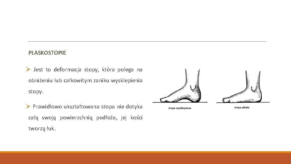 PŁASKOSTOPIE Ø Jest to deformacja stopy, która polega na obniżeniu lub całkowitym zaniku wysklepienia