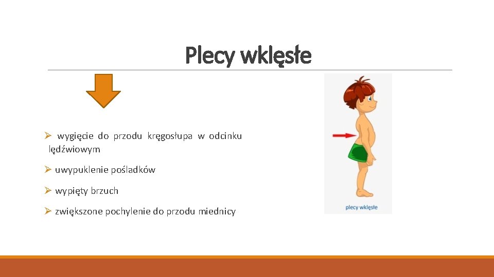 Plecy wklęsłe Ø wygięcie do przodu kręgosłupa w odcinku lędźwiowym Ø uwypuklenie pośladków Ø