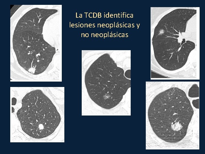 La TCDB identifica lesiones neoplásicas y no neoplásicas 