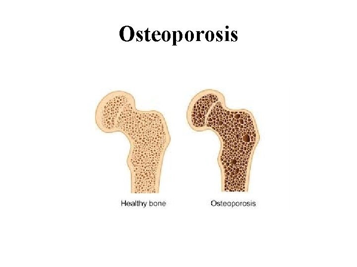 Osteoporosis Osteoporosis