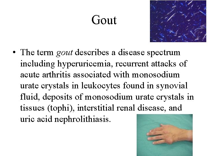 Gout • The term gout describes a disease spectrum including hyperuricemia, recurrent attacks of Gout • The term gout describes a disease spectrum including hyperuricemia, recurrent attacks of