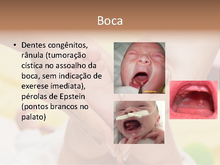 Boca • Dentes congênitos, rânula (tumoração cística no assoalho da boca, sem indicação de