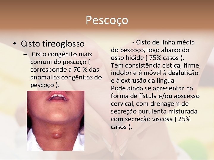 Pescoço • Cisto tireoglosso – Cisto congênito mais comum do pescoço ( corresponde a