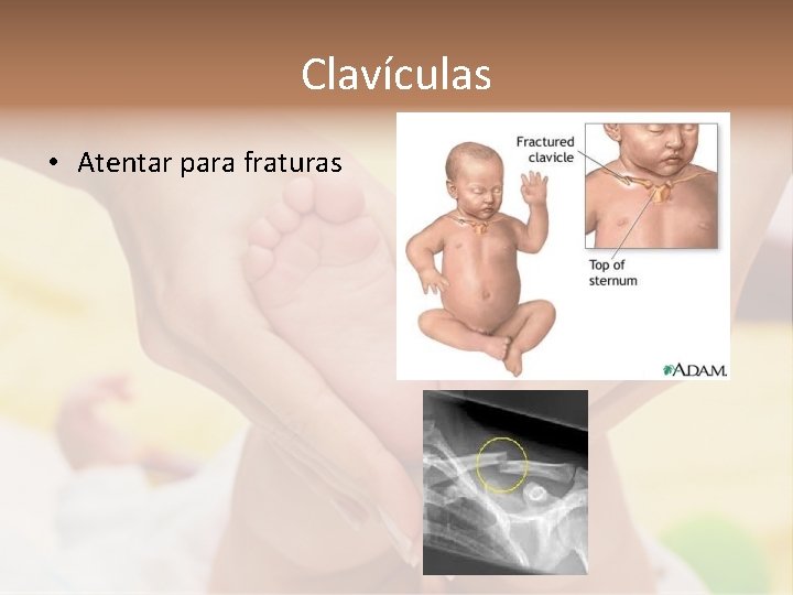 Clavículas • Atentar para fraturas 