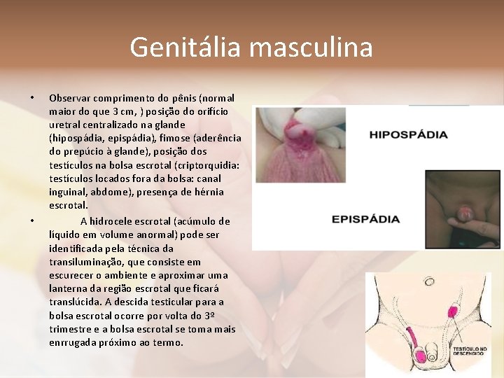 Genitália masculina • • Observar comprimento do pênis (normal maior do que 3 cm,