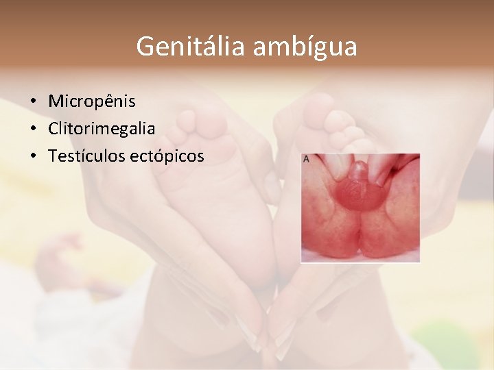 Genitália ambígua • Micropênis • Clitorimegalia • Testículos ectópicos 