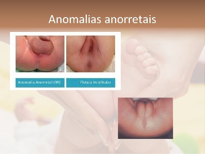 Anomalias anorretais 