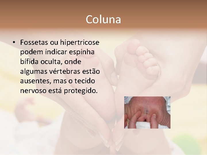 Coluna • Fossetas ou hipertricose podem indicar espinha bífida oculta, onde algumas vértebras estão