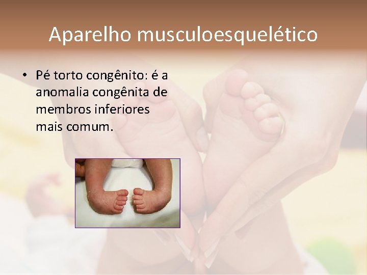 Aparelho musculoesquelético • Pé torto congênito: é a anomalia congênita de membros inferiores mais