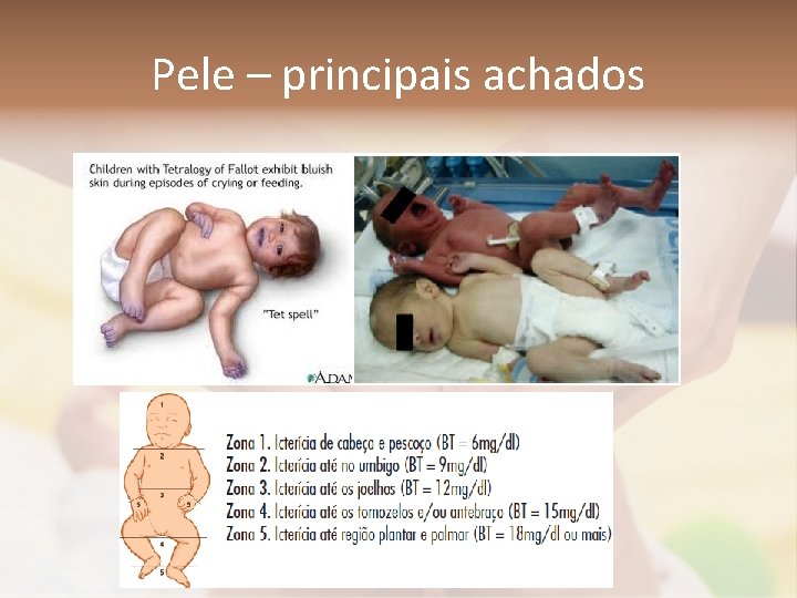 Pele – principais achados 